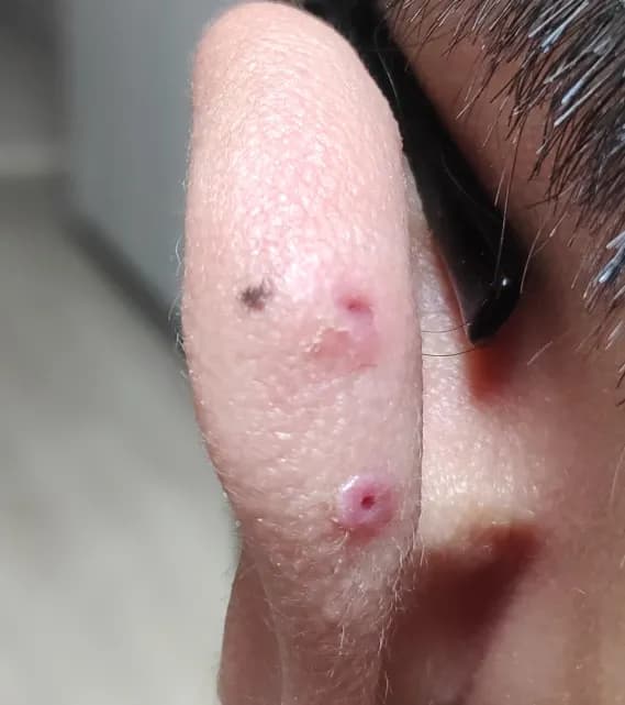 Registro de 8 semanas usando almohadillas para queloides-11