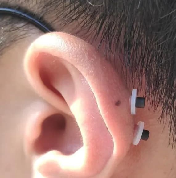 Registro de 8 semanas usando almohadillas para queloides-4