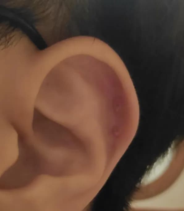 Registro de 8 semanas usando almohadillas para queloides-6