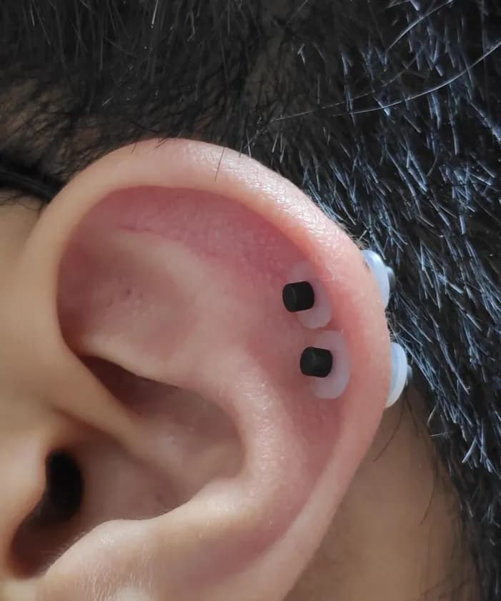 Registro de 8 semanas usando almohadillas para queloides-7