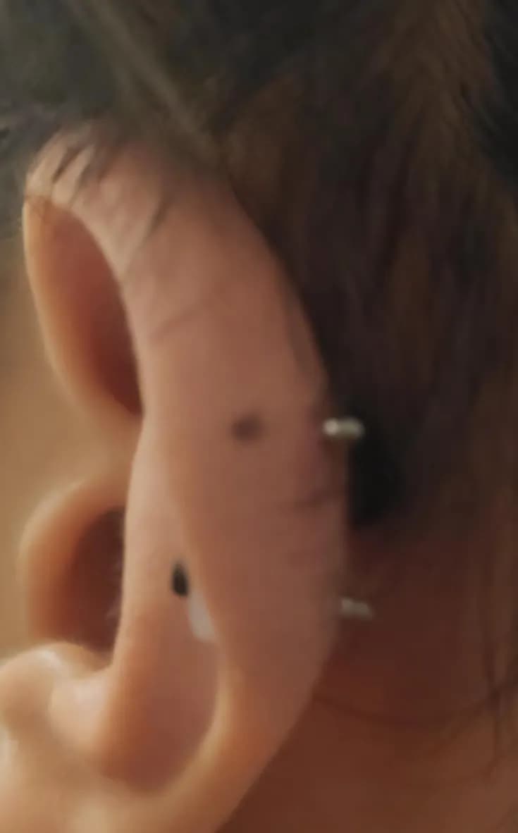 Registro de 8 semanas usando almohadillas para queloides-8