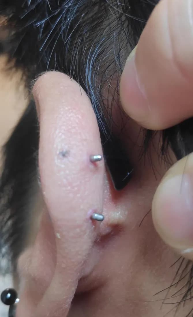 Registro de 8 semanas usando almohadillas para queloides-9