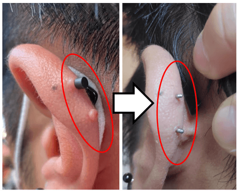 살튀 패드 착용 8주간의 기록