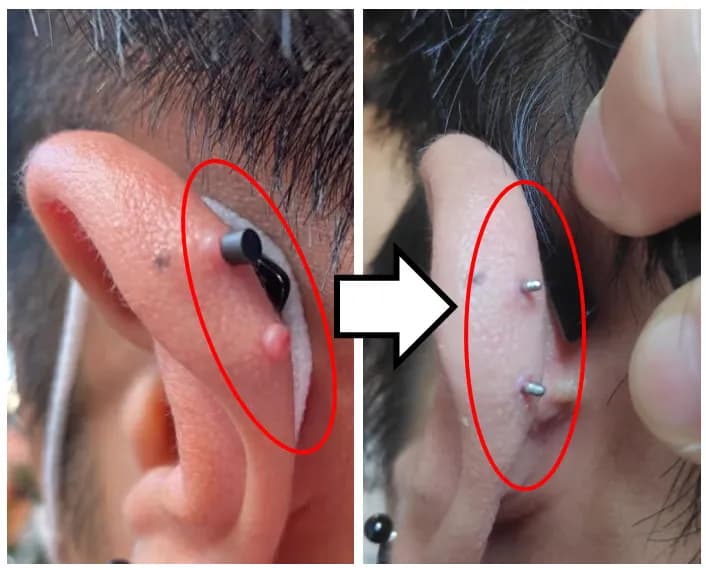 Registro de 8 semanas usando almohadillas para queloides-10