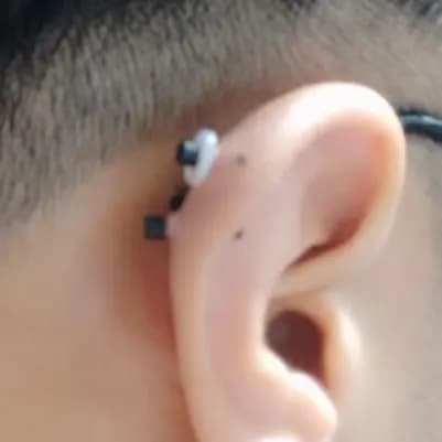 Registro de 8 semanas usando almohadillas para queloides-3