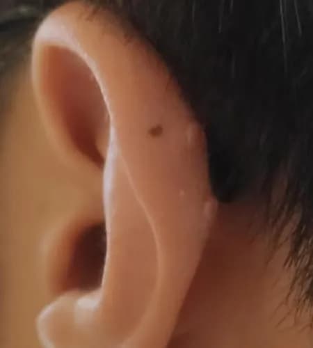 Registro de 8 semanas usando almohadillas para queloides-5