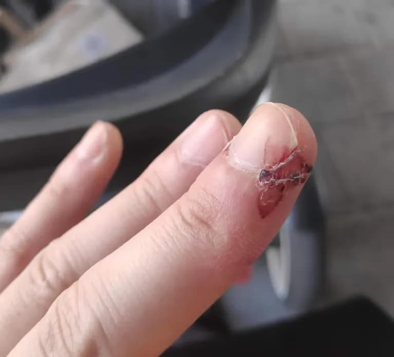 Tiempo de recuperación de una herida cortante-2