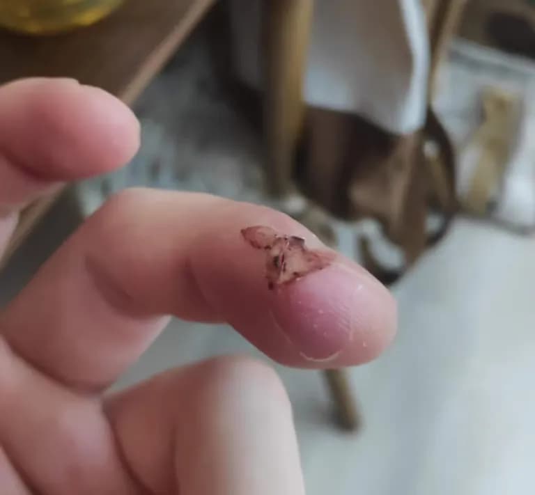 Tiempo de recuperación de una herida cortante-3