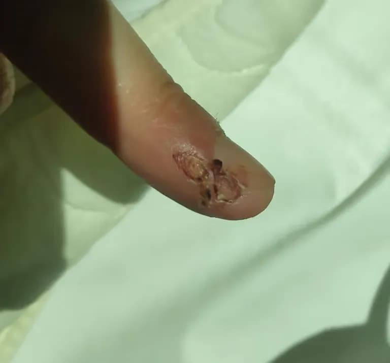 Tiempo de recuperación de una herida cortante-6