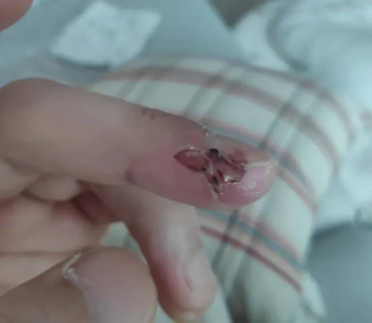 Tiempo de recuperación de una herida cortante-7