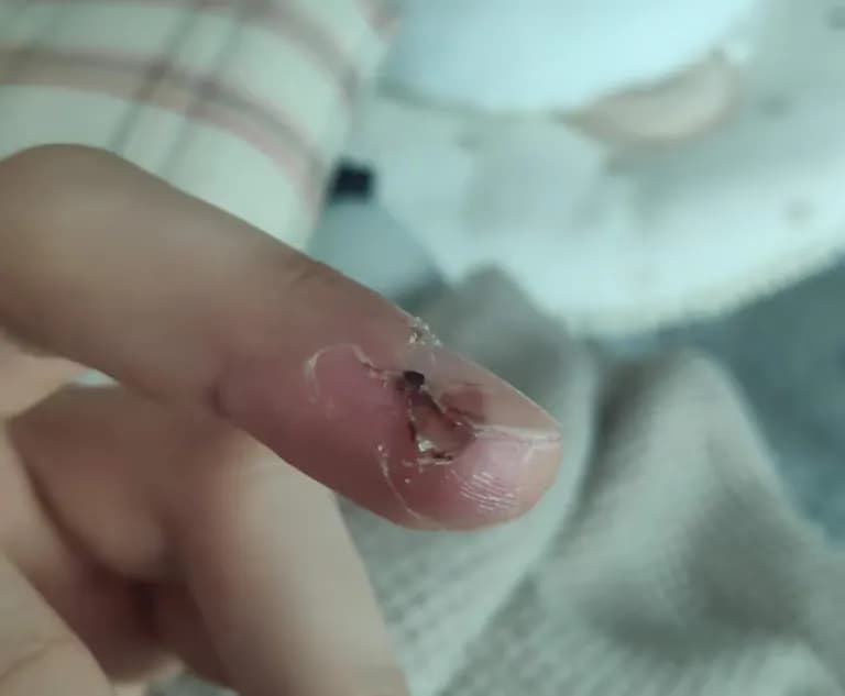 Tiempo de recuperación de una herida cortante-8