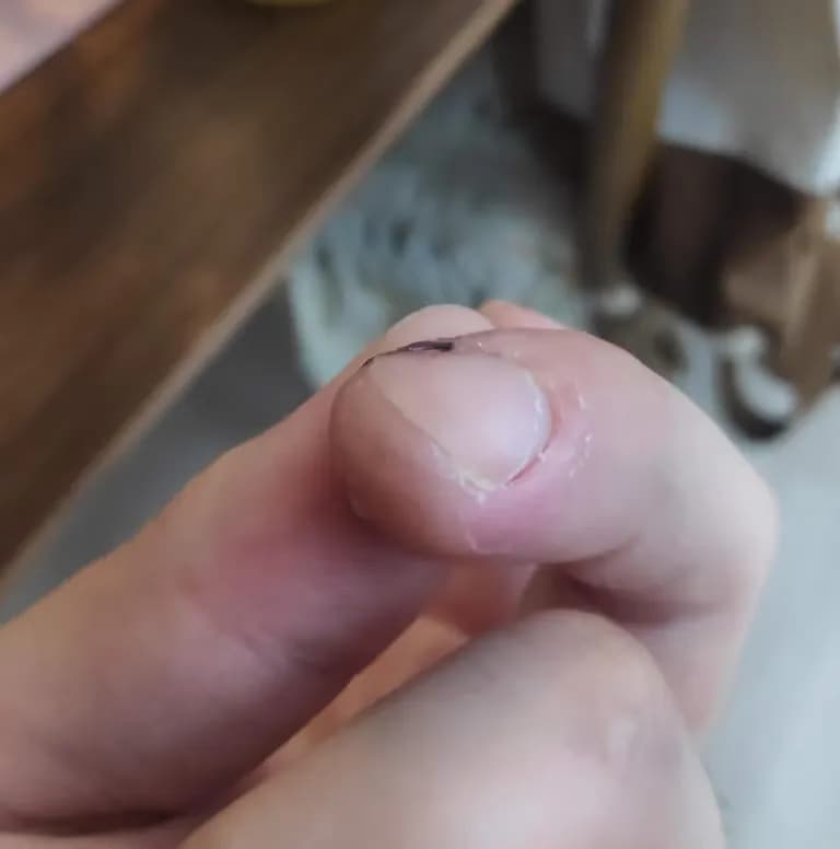 Tiempo de recuperación de una herida cortante-4