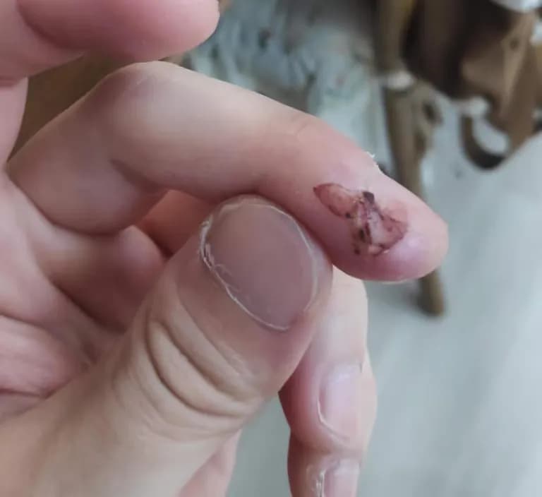 Tiempo de recuperación de una herida cortante-5