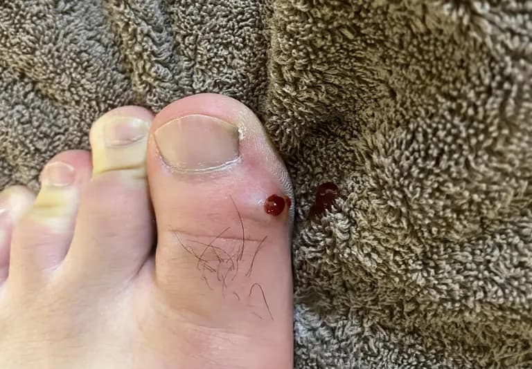 脚趾上的囊肿——反复挤压记录-14