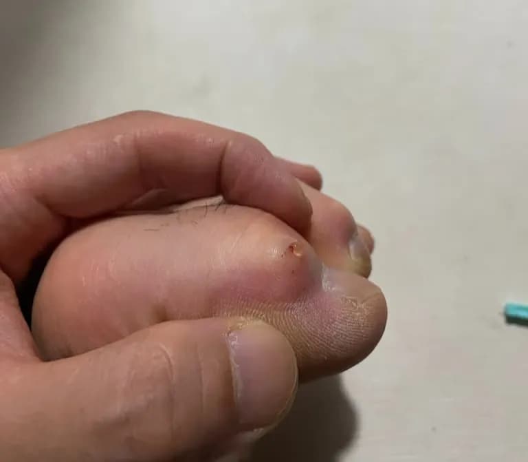 脚趾上的囊肿——反复挤压记录-3