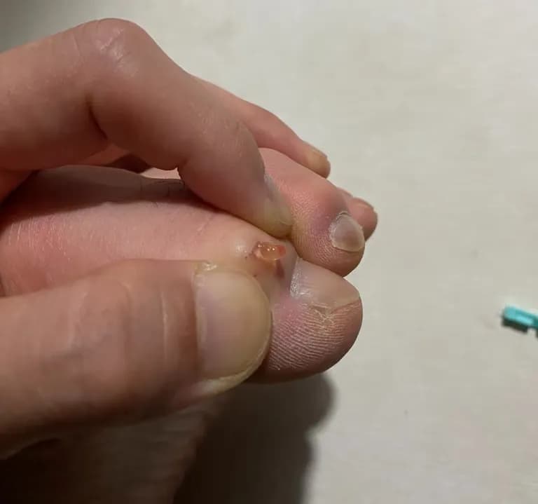 脚趾上的囊肿——反复挤压记录-4