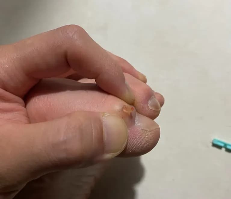 脚趾上的囊肿——反复挤压记录-5