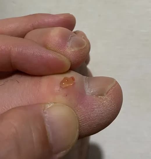 脚趾上的囊肿——反复挤压记录-9