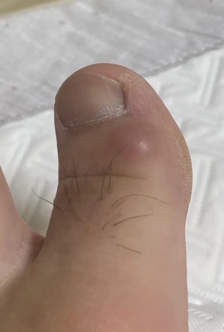 脚趾上的囊肿——反复挤压记录-6