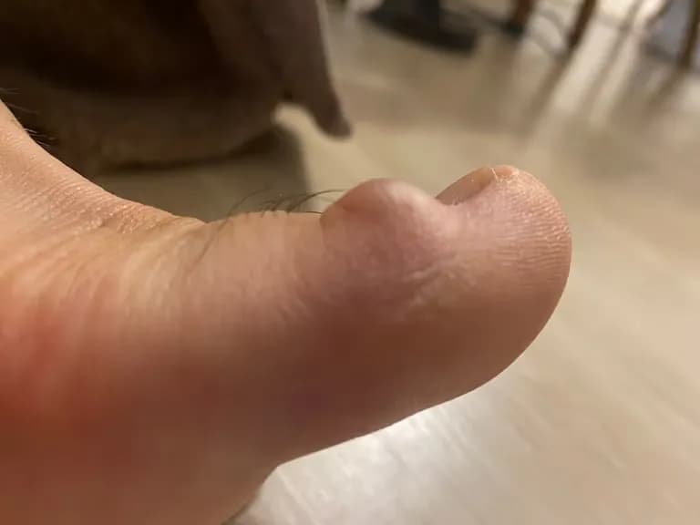 脚趾上的囊肿——反复挤压记录-11