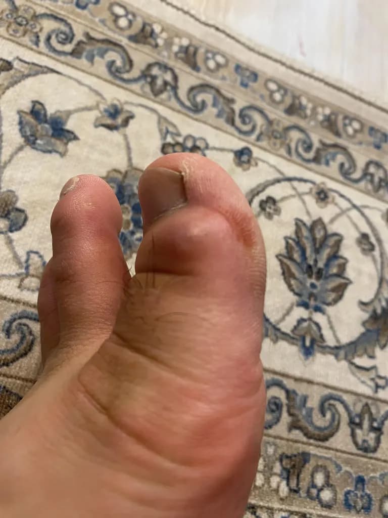 脚趾上的囊肿——反复挤压记录-15