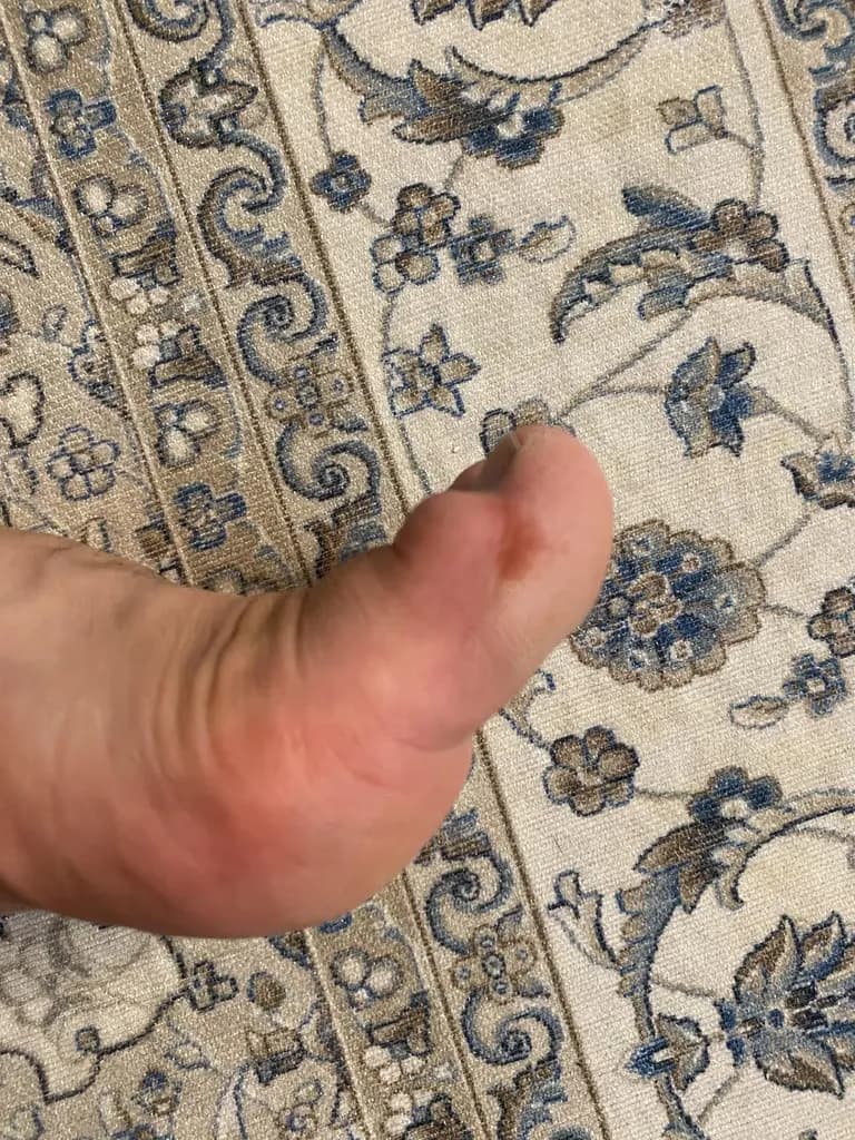 脚趾上的囊肿——反复挤压记录-16