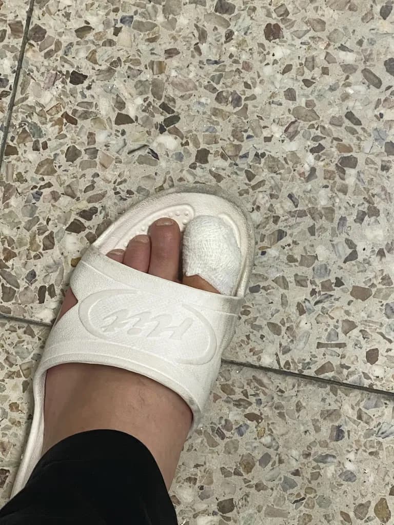 足の指のガングリオン手術レビュー、手術傷の管理方法-2