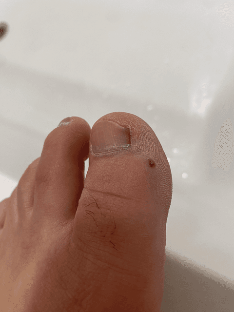 발가락 결절종 수술 후기, 수술 상처 관리 방법