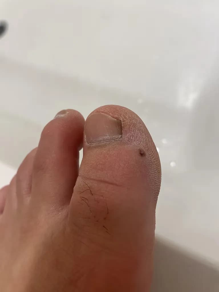 足の指のガングリオン手術レビュー、手術傷の管理方法-1