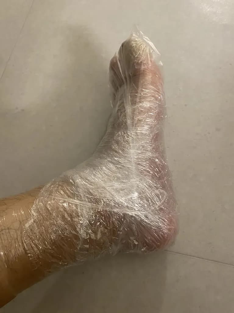 足の指のガングリオン手術レビュー、手術傷の管理方法-8