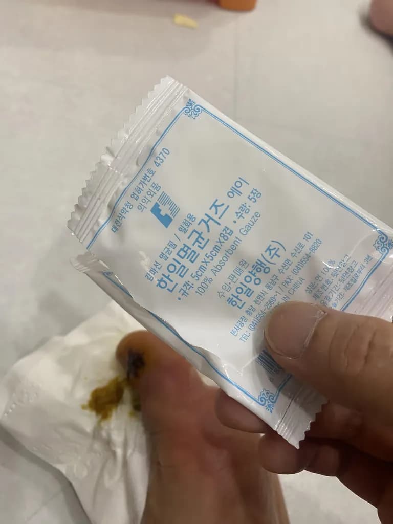 足の指のガングリオン手術レビュー、手術傷の管理方法-7