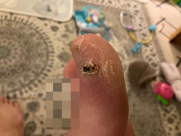 足の指のガングリオン手術レビュー、手術傷の管理方法-16