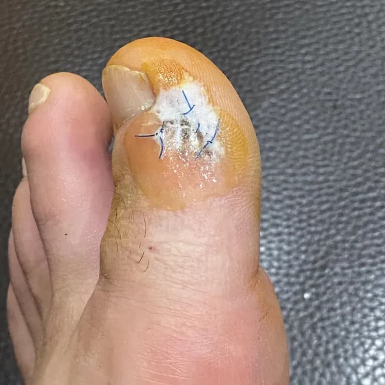 足の指のガングリオン手術レビュー、手術傷の管理方法-3