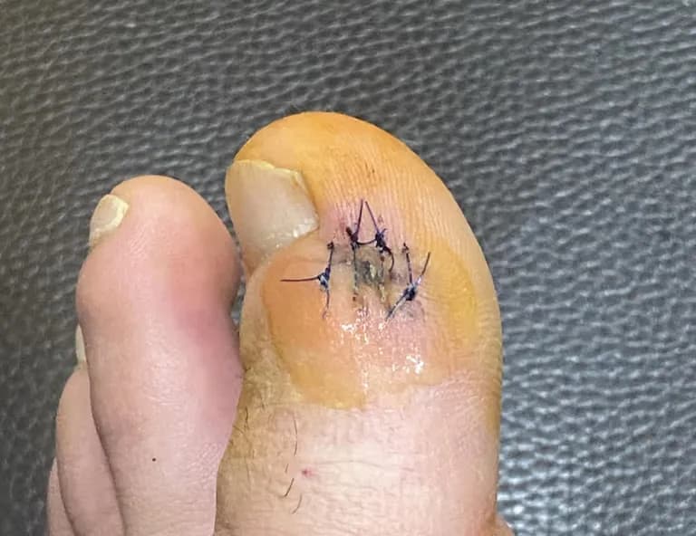 足の指のガングリオン手術レビュー、手術傷の管理方法-4