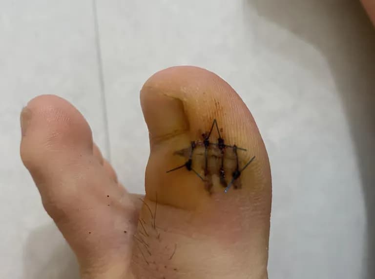 足の指のガングリオン手術レビュー、手術傷の管理方法-5