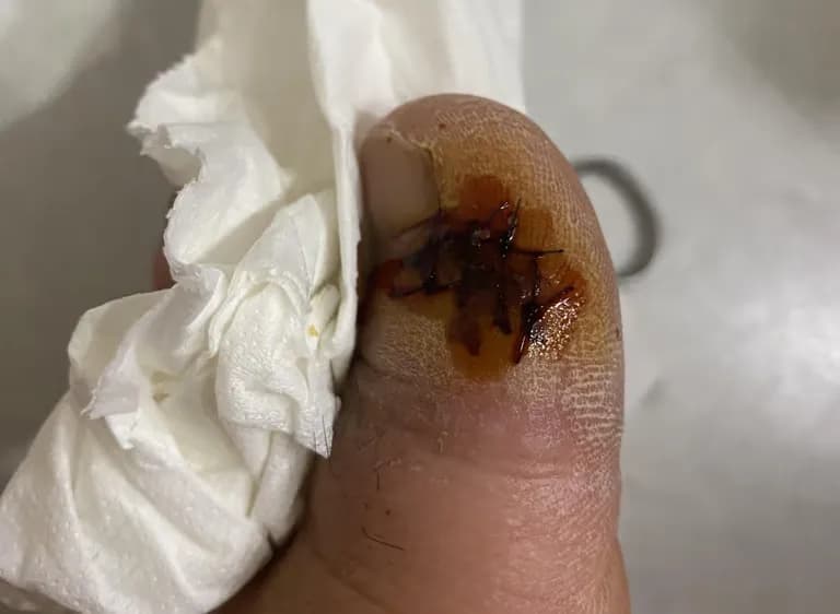 足の指のガングリオン手術レビュー、手術傷の管理方法-6