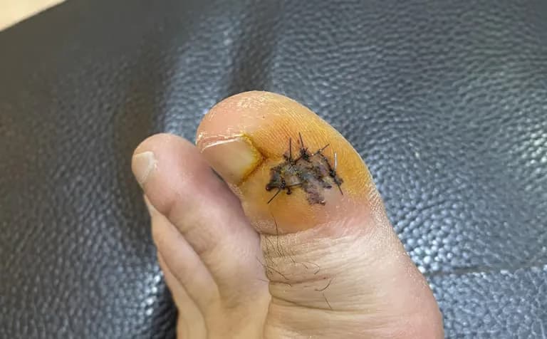 足の指のガングリオン手術レビュー、手術傷の管理方法-9