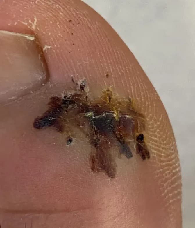 足の指のガングリオン手術レビュー、手術傷の管理方法-10