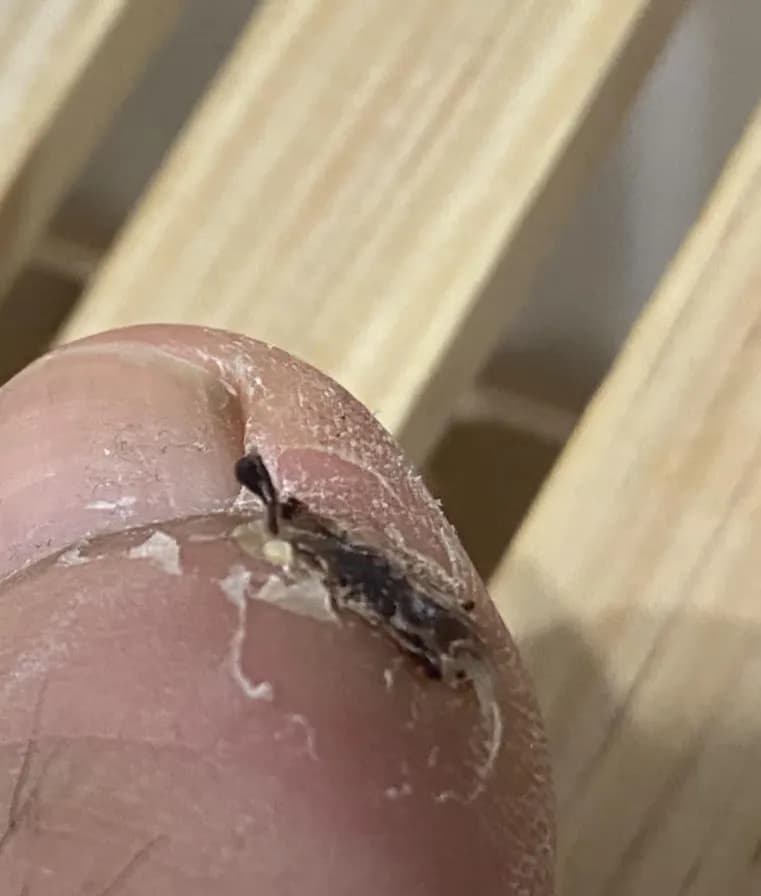 足の指のガングリオン手術レビュー、手術傷の管理方法-11