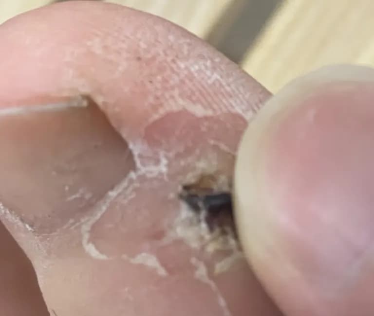 足の指のガングリオン手術レビュー、手術傷の管理方法-12