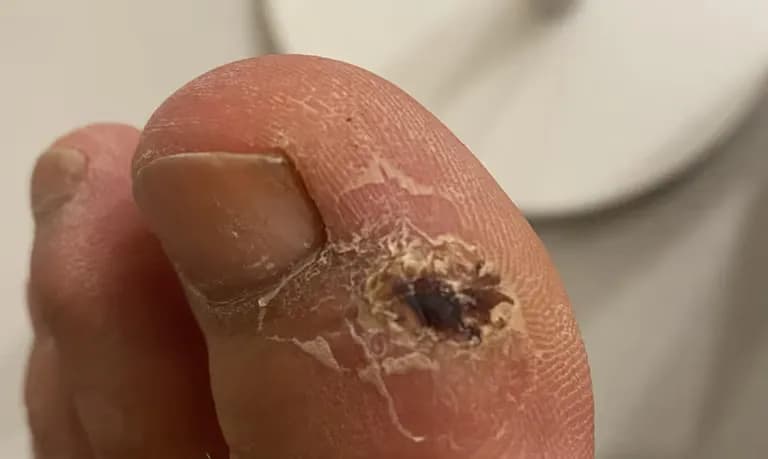 足の指のガングリオン手術レビュー、手術傷の管理方法-13