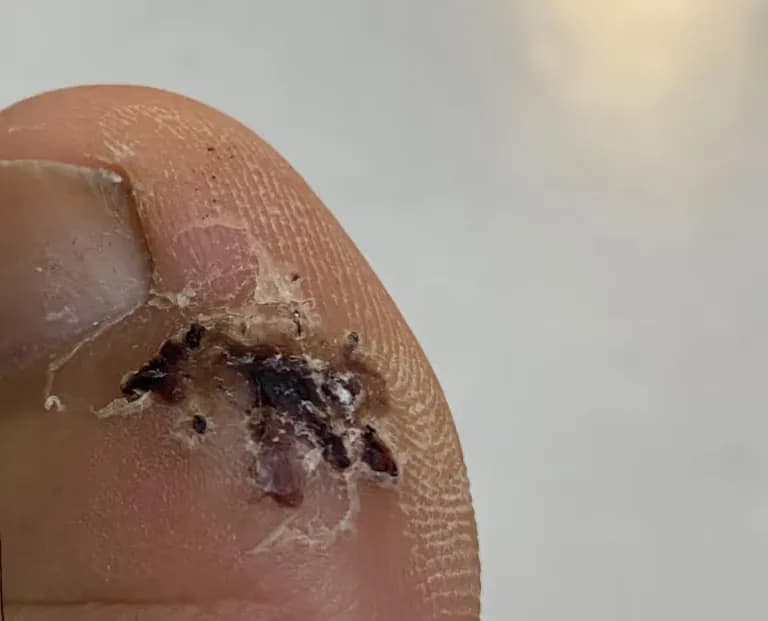 足の指のガングリオン手術レビュー、手術傷の管理方法-14