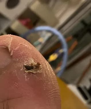 足の指のガングリオン手術レビュー、手術傷の管理方法-15