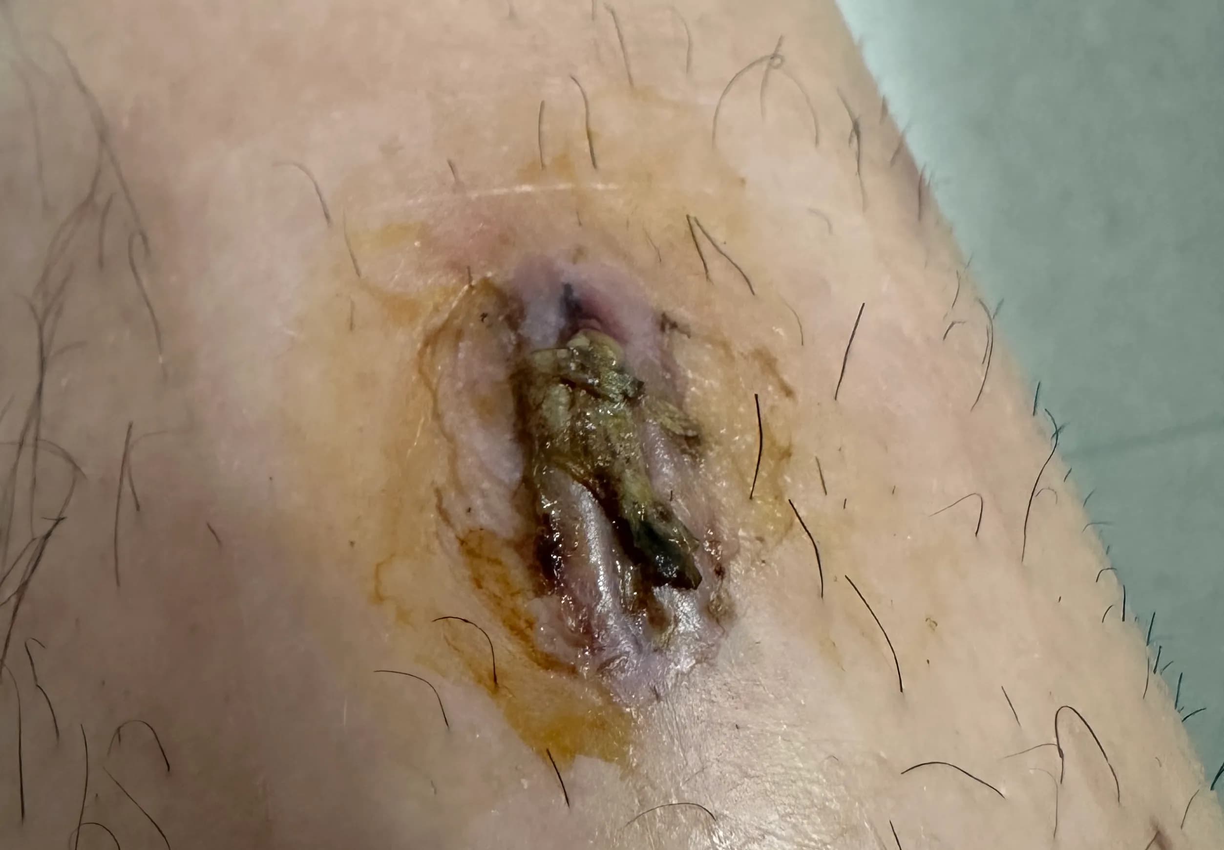 상계 백병원 응급실 후기 - 상처 꿰매는 기준, 드레싱 방법, 꿰맨 상처 회복 기간-20