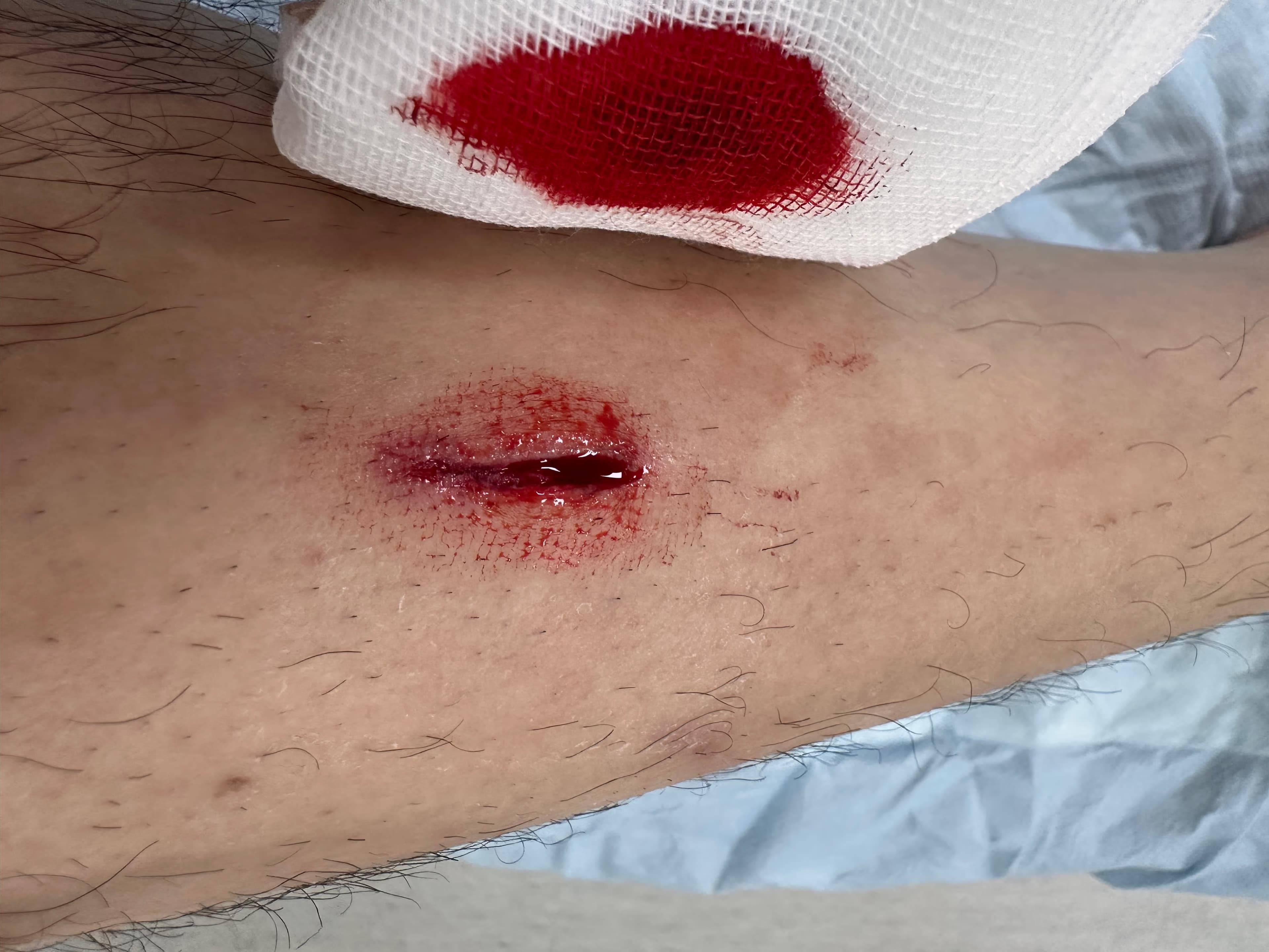 상계 백병원 응급실 후기 - 상처 꿰매는 기준, 드레싱 방법, 꿰맨 상처 회복 기간-7