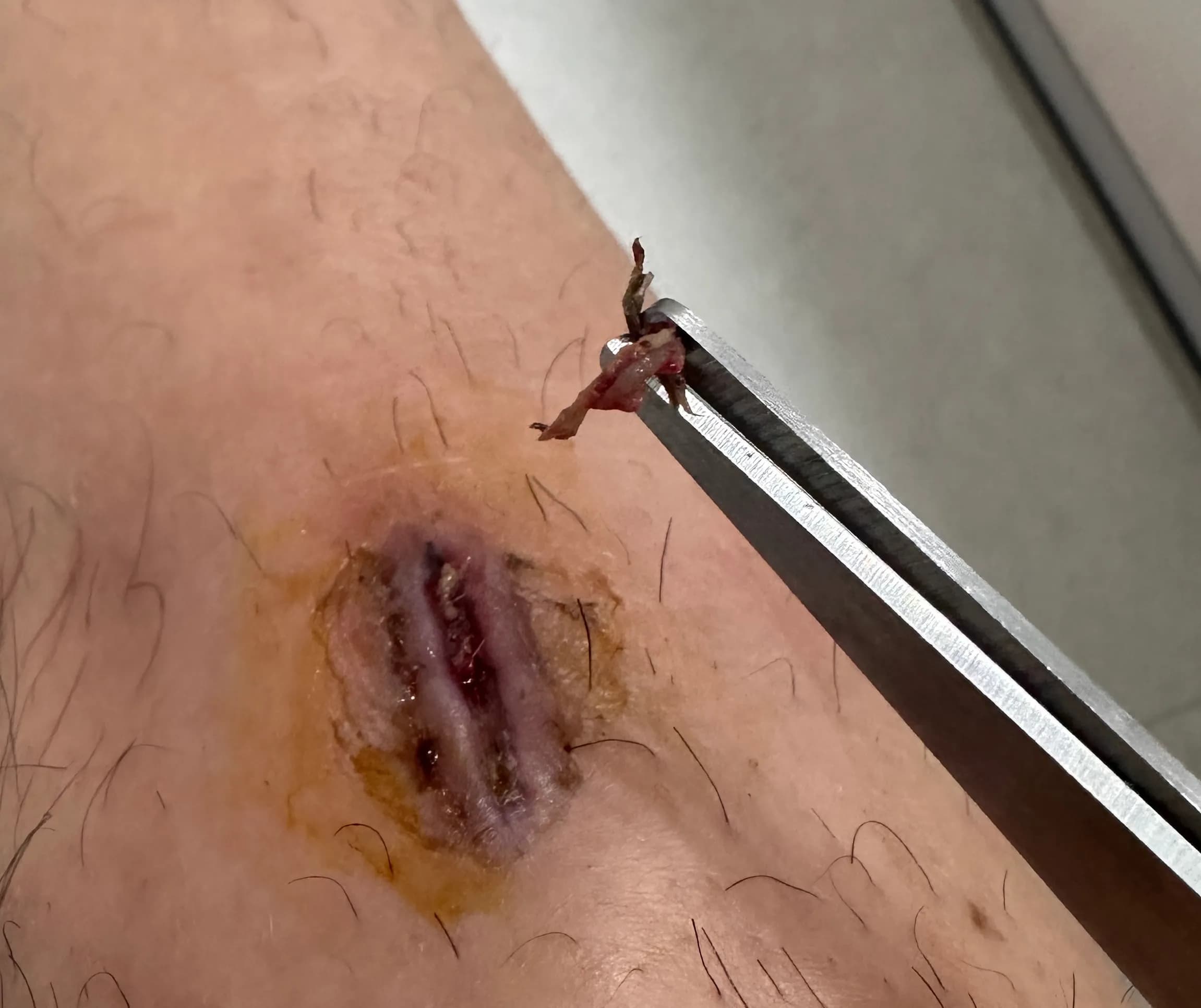 상계 백병원 응급실 후기 - 상처 꿰매는 기준, 드레싱 방법, 꿰맨 상처 회복 기간-21