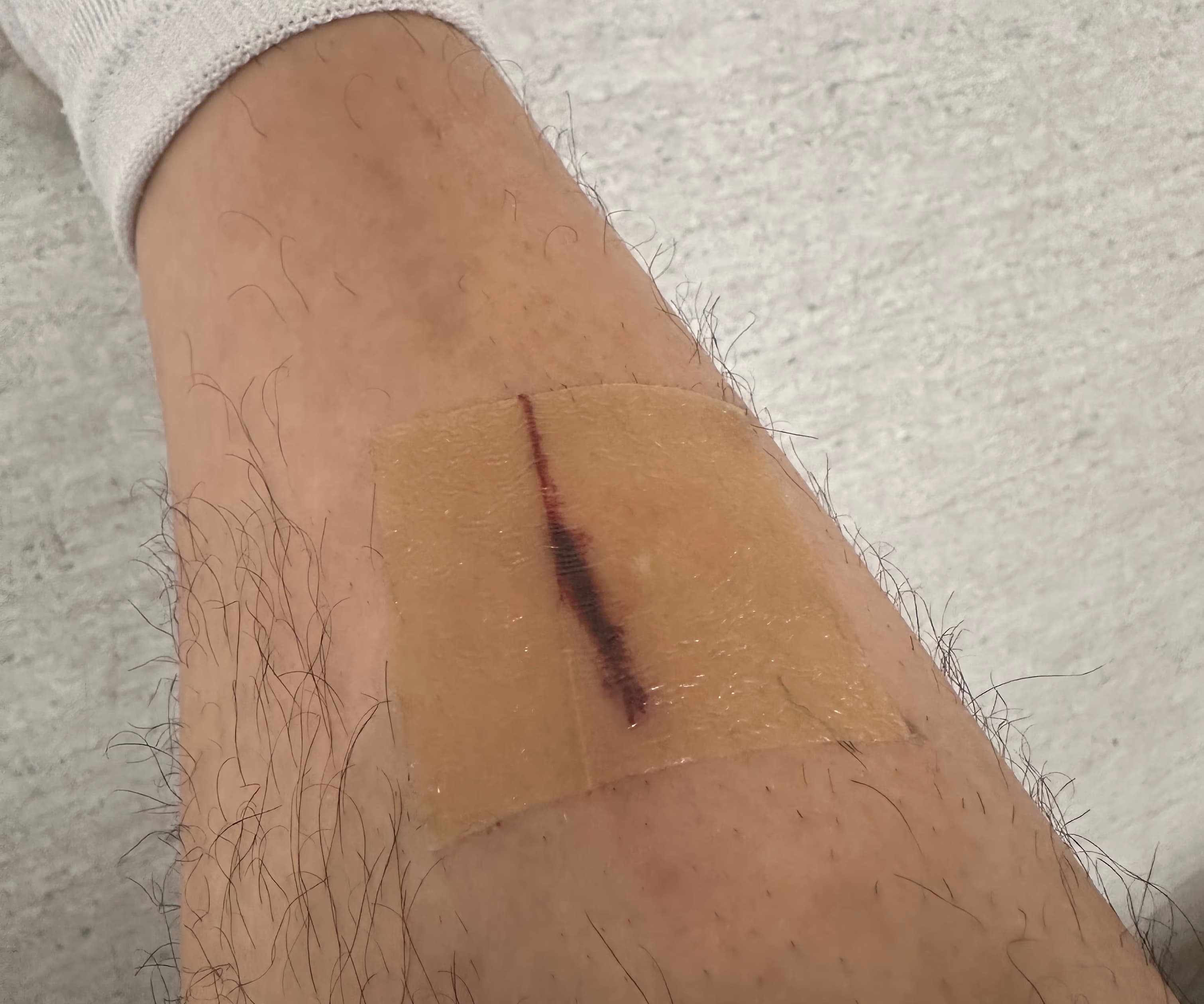 상계 백병원 응급실 후기 - 상처 꿰매는 기준, 드레싱 방법, 꿰맨 상처 회복 기간-1