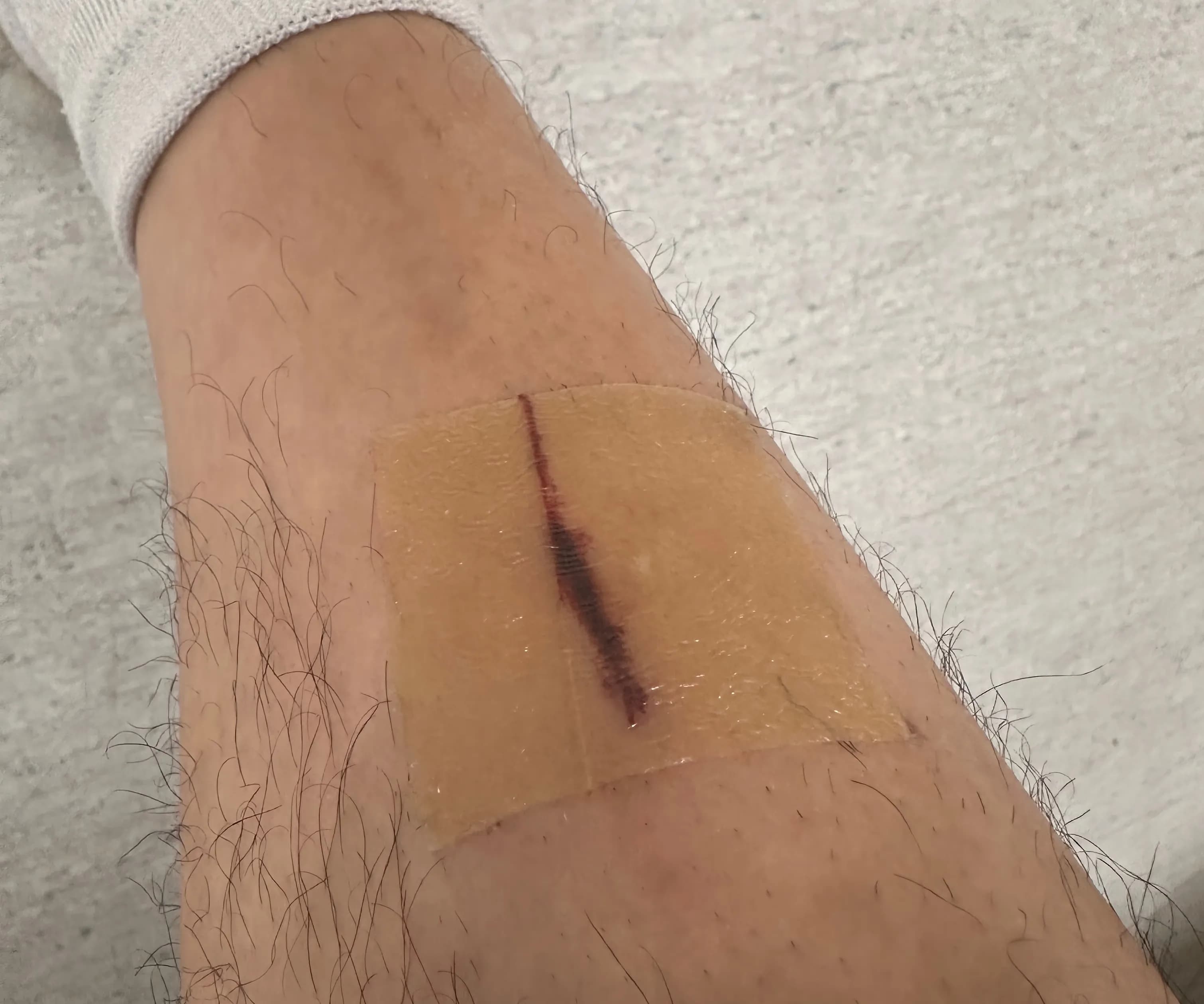 サンゲ・ベク病院救急外来の口コミ - 縫合の基準、ドレッシングの方法、縫った傷の回復期間-1