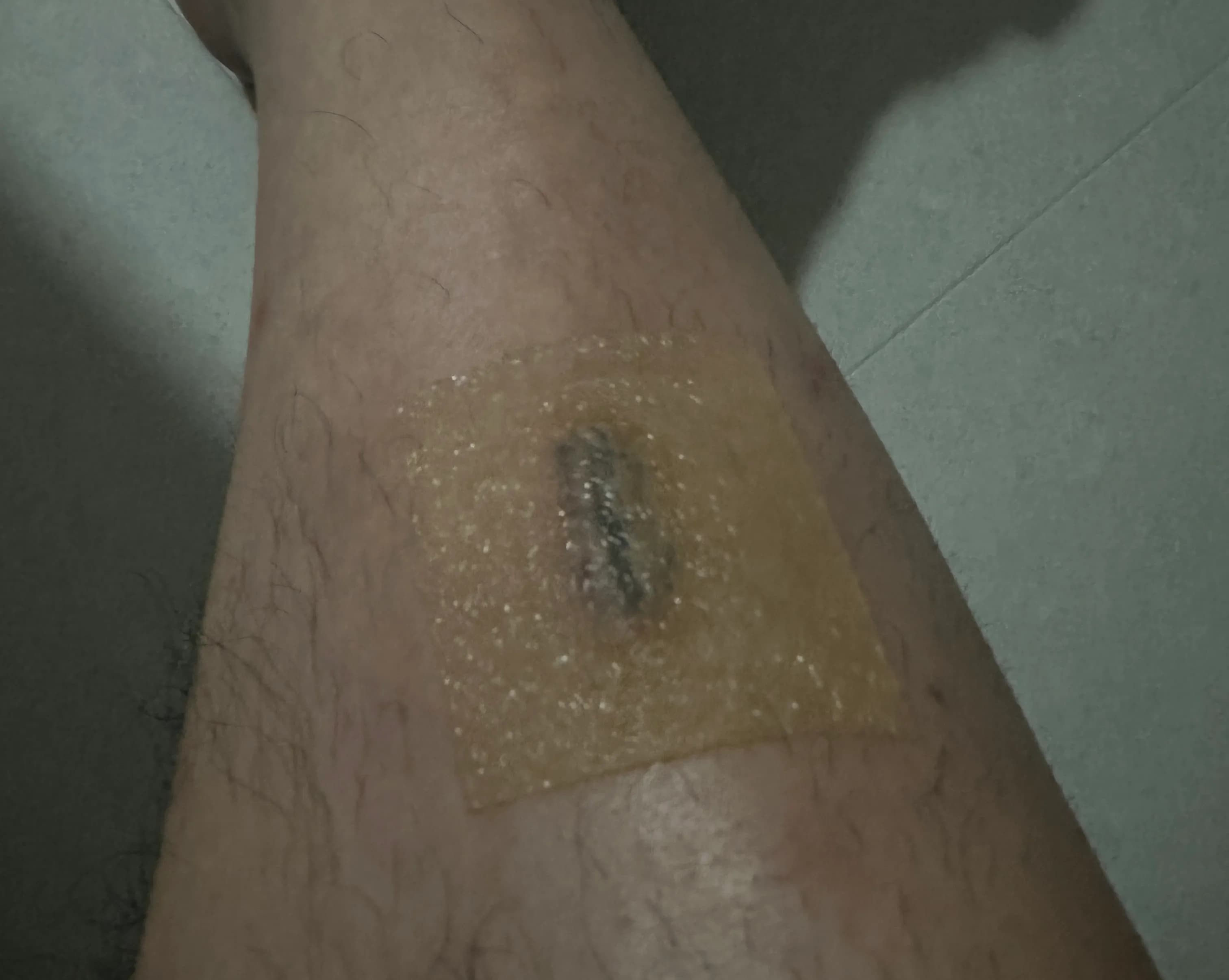 상계 백병원 응급실 후기 - 상처 꿰매는 기준, 드레싱 방법, 꿰맨 상처 회복 기간-19