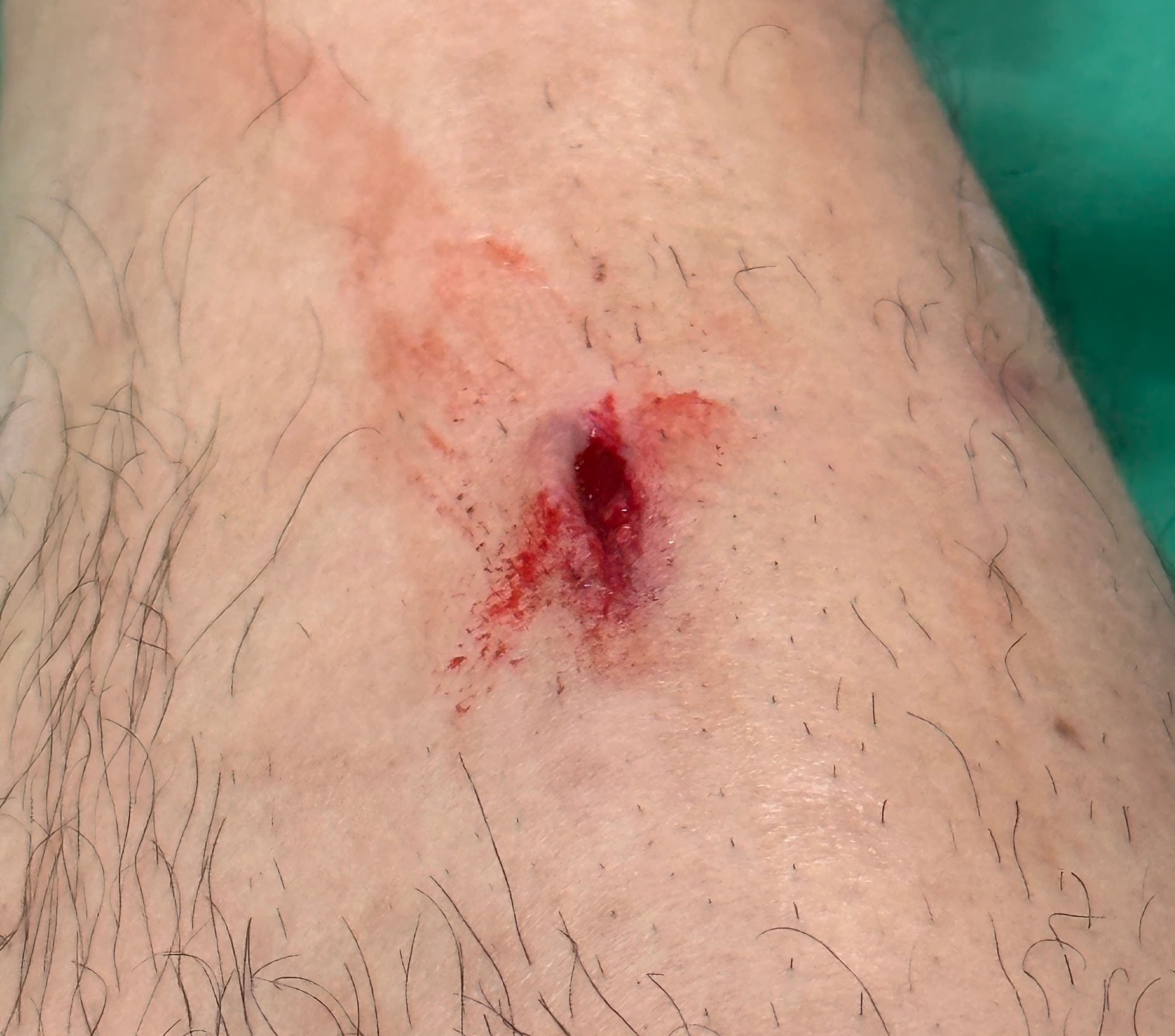 상계 백병원 응급실 후기 - 상처 꿰매는 기준, 드레싱 방법, 꿰맨 상처 회복 기간-8